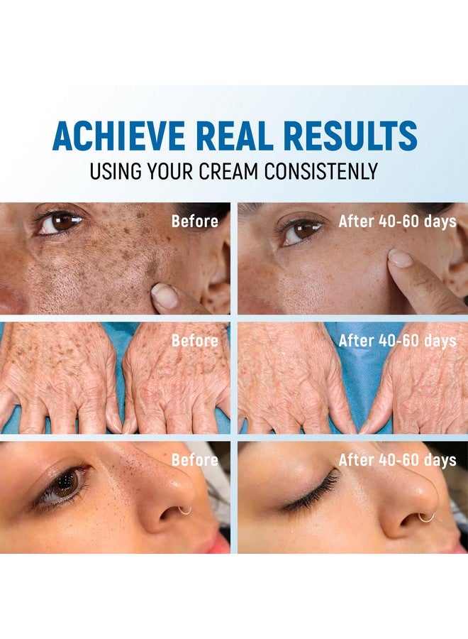 PENEBELLA Dark Spot Remover for Face and Body - 43% Active Ingredients Blend with Vitamin C, Niacinamide, Collagen - Skin Lightening Cream for Women and Men - Dark Spot Corrector - Brightening Cream - Image 5