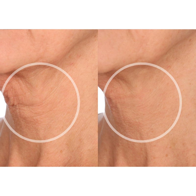 SiO Beauty FaceLift - Reusable Anti-Wrinkle Patches for Neck, Forehead, Eye & Smile - Overnight Smoothing Silicone for Fine Lines, Wrinkles, and Aging - Image 3