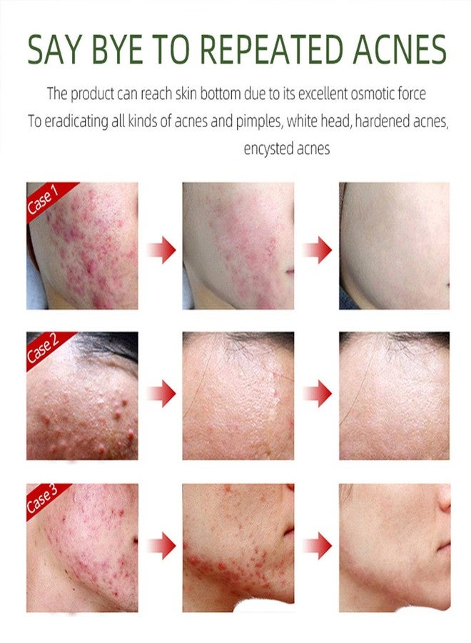 Grospe Acne Removing Face Cream,Natural Ingredients Professionally Remove Acne Marks,For Teens & Adults Anti-acne Moisturizer Pimple Cream - Image 5