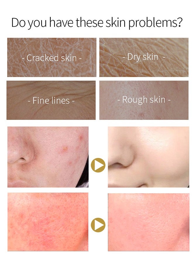 Snail Essence Cream - With Snail Secretion Filtrate, Moisturizing Acne Scar Removal Cream Improve Skin Nourishing Collagen Essence Cream For Improve Damaged Skin