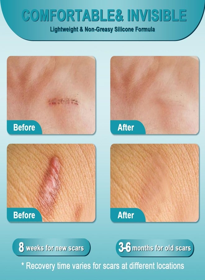 Scar Cream, Advanced Scar Gel for Old & New Scars, Professional Scar Removal Cream For Surgical Scars, Face, Body, Leg, Acne, Stitches, Burns, C-Section, Keloids, 1.76oz - Image 3