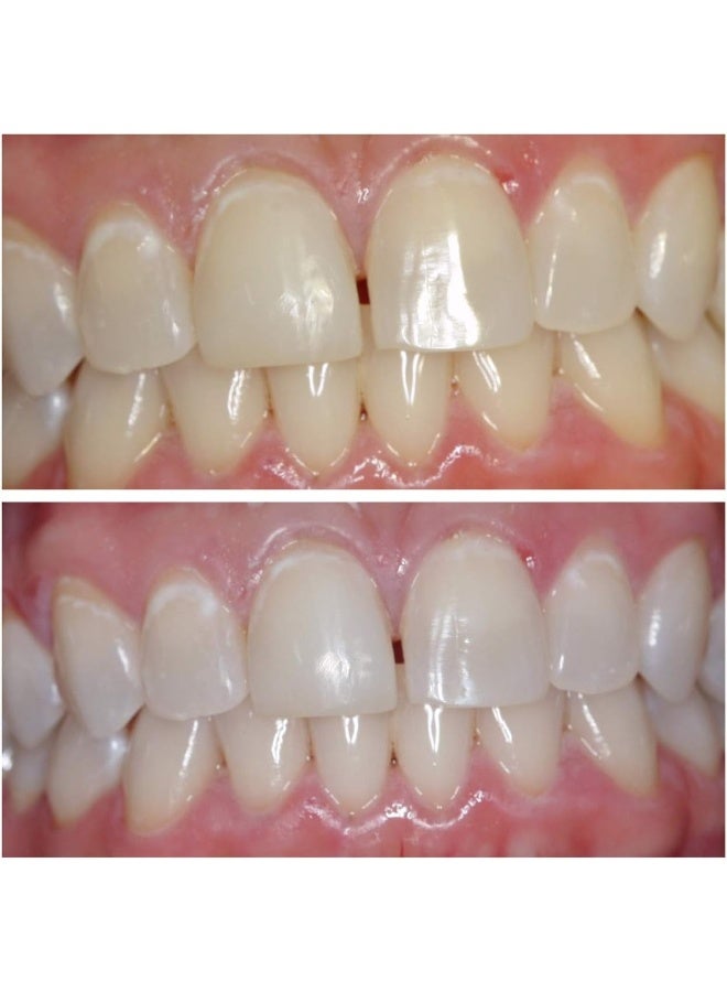 Ultra White جل تبييض الأسنان ألترا وايت 22% - 5 أنابيب كبيرة 3.8 مل - Image 5