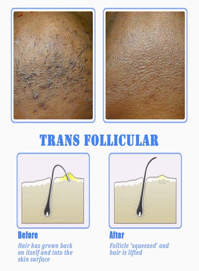 تايلامي فرشاة تايلايمي لتقشير البشرة وعلاج الشعر النامي تحت الجلد - لعلاج ومنع ظهور نتوءات منطقة البكيني ونتوءات الحلاقة - حل لبشرة ناعمة كالحرير للرجال والنساء (أزرق) - Image 4