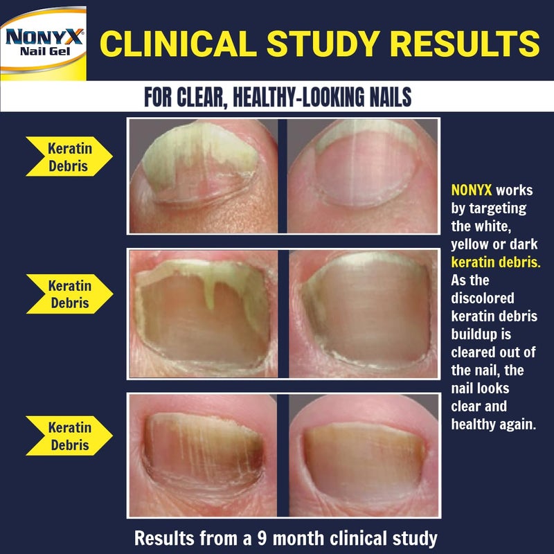 NONYX Fungal Nail Clarifying Gel | Clinically Proven for Discolored, Thick, Brittle, Yellow, Lifted, and other signs of Fungus-Damaged Toenails | 90% of Nails Improve | Over 8 million sold - Image 3