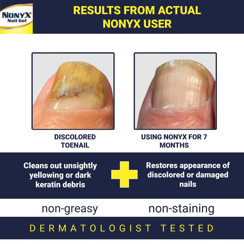 NONYX Fungal Nail Clarifying Gel | Clinically Proven for Discolored, Thick, Brittle, Yellow, Lifted, and other signs of Fungus-Damaged Toenails | 90% of Nails Improve | Over 8 million sold - Image 2