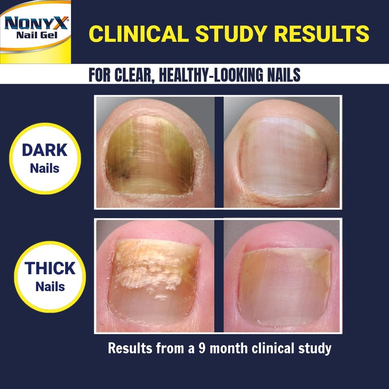 NONYX Fungal Nail Clarifying Gel | Clinically Proven for Discolored, Thick, Brittle, Yellow, Lifted, and other signs of Fungus-Damaged Toenails | 90% of Nails Improve | Over 8 million sold - Image 4