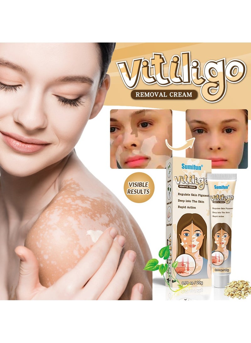 سوميفون مرهم البهاق، كريم للعناية بالبشرة، يقلل البقع البيضاء ويحسن التصبغ، 20 غرام - Image 4