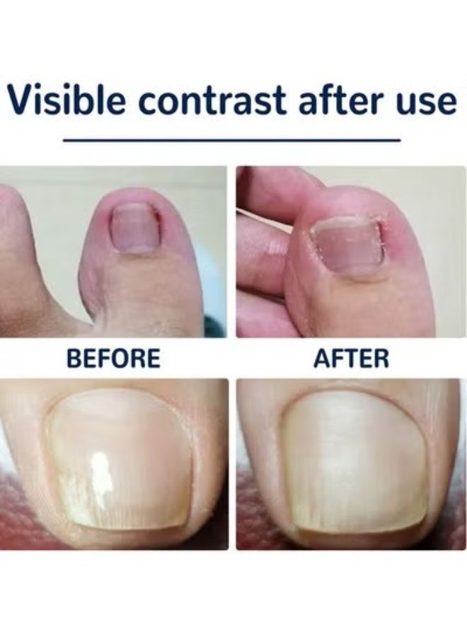 إيلهو تصحيح اصبع القدم و اظافر اصبع القدم - Image 4