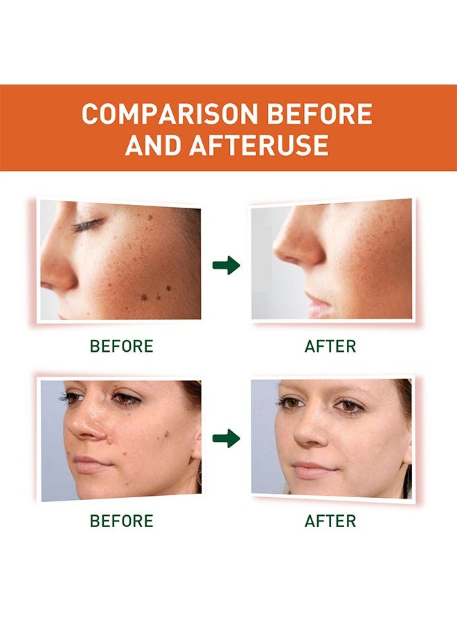 SOUTH MOON Skin Tag Remover - Wart Remover Fast Acting & Effective Wart Removal Treatment for All Skin Type 30ml  - Image 2