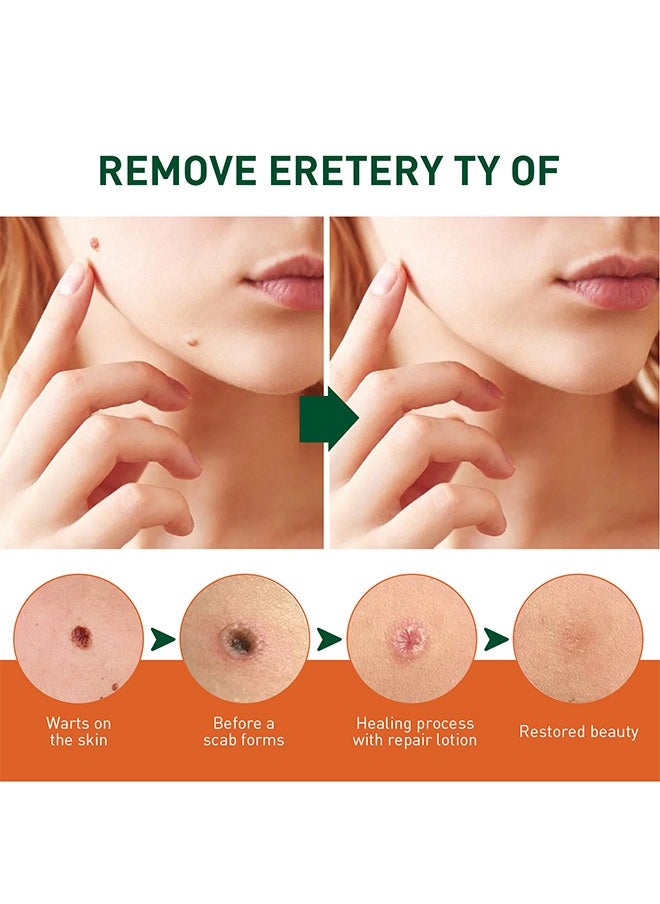 SOUTH MOON Skin Tag Remover - Wart Remover Fast Acting & Effective Wart Removal Treatment for All Skin Type 30ml  - Image 3