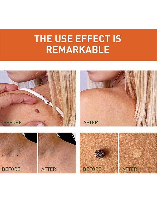 SOUTH MOON Skin Tag Remover - Wart Remover Fast Acting & Effective Wart Removal Treatment for All Skin Type 30ml  - Image 4