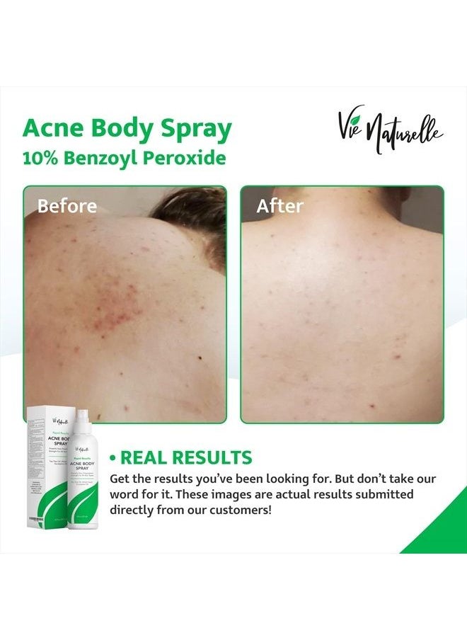 Vie Naturelle Face, Body Acne Spray with Benzoyl Peroxide - Salicylic Acid - Butt, Back Acne Treatment - Cystic Hormonal Acne Treatment, Body, Chest Spray with Tea Tree Oil - for Men, Women, Teens - Acne Body Spray  - Image 2