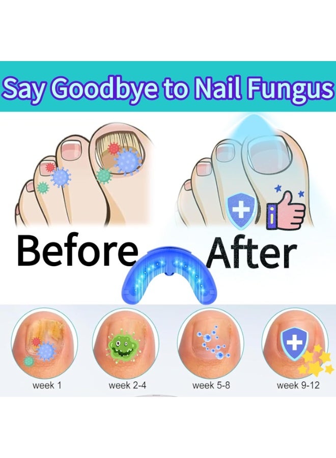 2026 جهاز الليزر الفطري للأظافر 99٪ العدوى الفطرية القضاء عليها في 3 دقائق 30 / 60 / 99 من التحكم في الوقت الذكي / الذكي الضوء الفطري للأظافر استعادة الأظافر الصحية وتجديد الثقة بالنفس الأبيض - Image 4