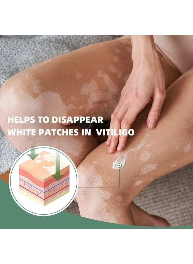 Sumifun Vitiligo Relief Cream 20G, Treatment for Skin Vitiligo Ointment, Fade White Spot and Improve Skin Pigmentation Cream, Vitiligo Cream for Skin Healthy Care - Image 4