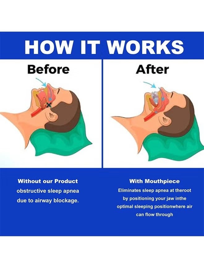 إيلهو مكافحة الشخير حارس الفم ، حارس الفم القابلة لإعادة الاستخدام لوقف الشخير في الليل أجهزة مكافحة الشخير مع الراحة حجم الشخير حارس الفم للرجال والنساء - Image 4