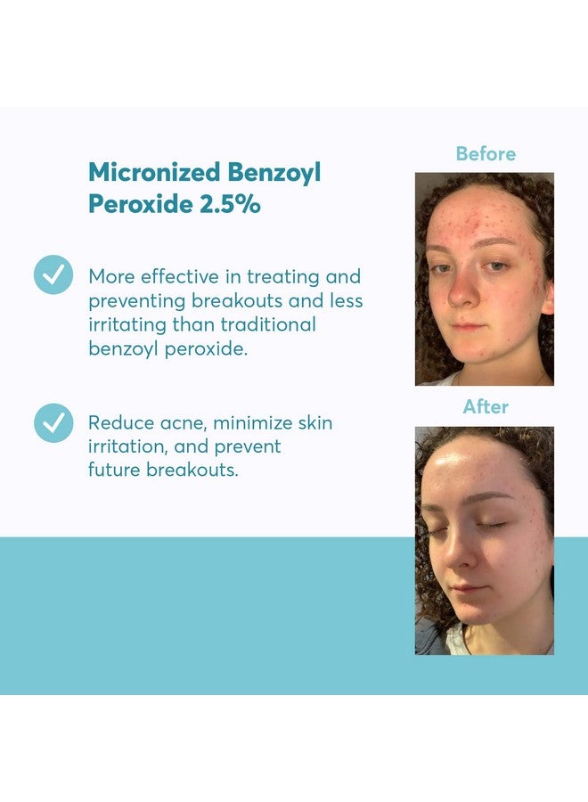 MDacne Acne Treatment Benzoyl Peroxide Cream 2.5% Unclogs Pores Reduces Blemishes & Enhanced With Plantbased Ingredients For Sensitive Skin - Image 2