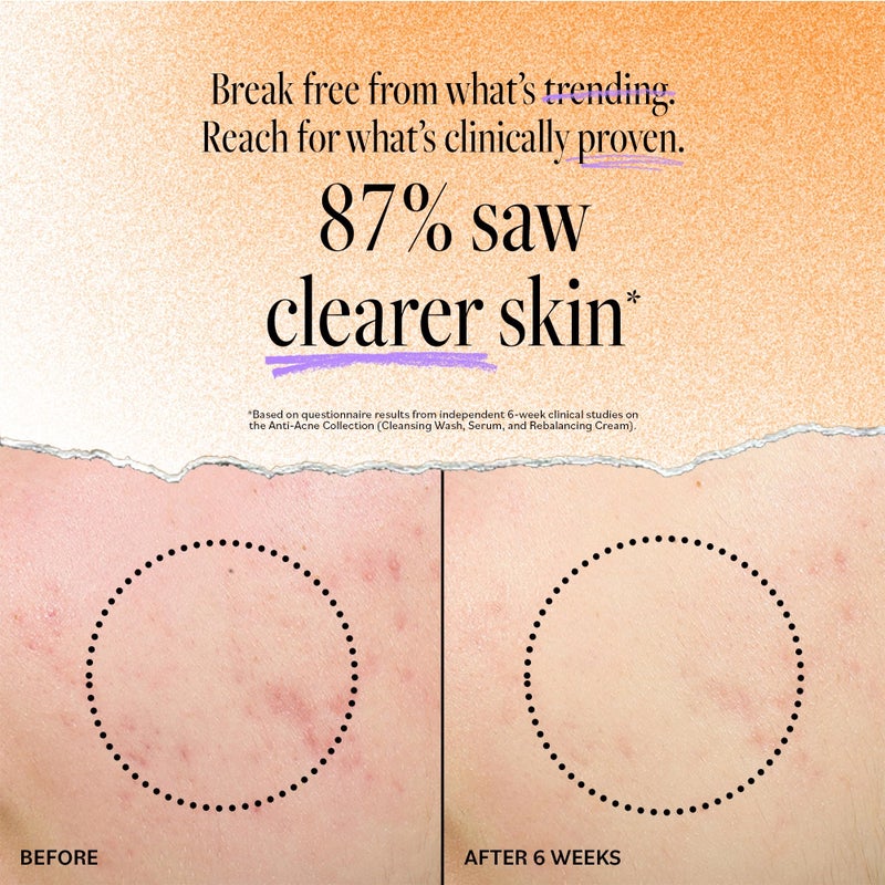 derma-e Derma E Acne Deep Pore Cleansing Wash â€“ Blemish Control Facial Cleanser with Salicylic Acid - Gentle Oil Control Face Wash Soothes and Balances Skin, 6 fl oz - Image 3