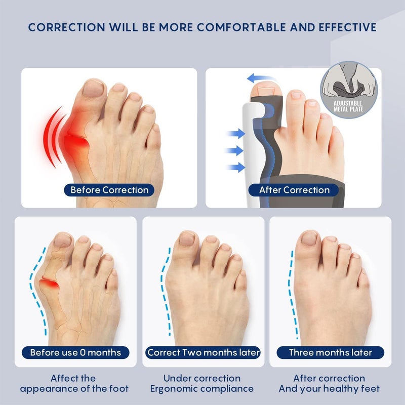 QualiTrue Bunion Corrector for Women and Men Toe Separator One Feet Bunion Splint, Big Toes Separation Pain Relief, Non-Surgical Adjustable Hallux Valgus Bunions Thumb Straightener, Hammer Toe Day Night Support (1 Bunion Corrector + 1 Toe Separator) - Image 2