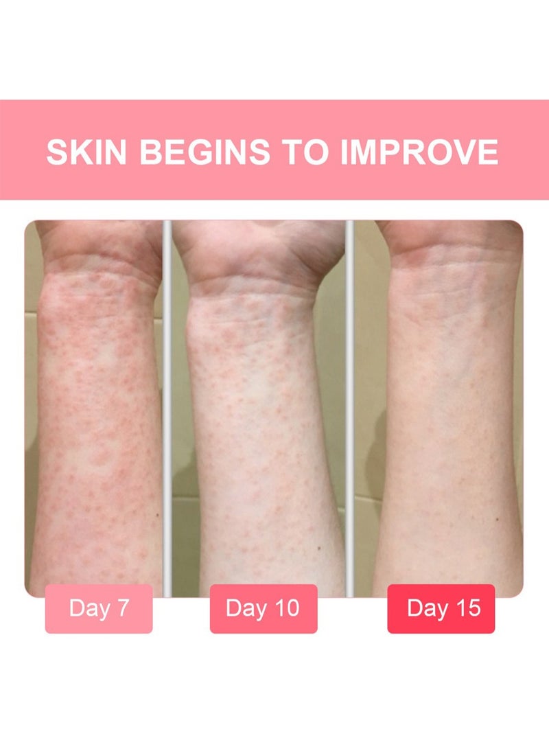 سوميفون كريم كالامين لتخفيف الأكزيما، مغذي وإصلاح فعال لتخفيف الحكة والالتهاب، قوة إضافية خفيفة تخفف من الوردية والأكزيما 20 جم - Image 4