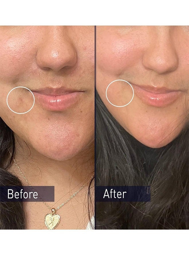 بانوكسيل Acne Foaming Wash Benzoyl Peroxide 10% Maximum Strength Antimicrobial(5.5 Oz),Clears Existing Acne And Helps Prevent New Breskouts From Forming,Trests Acne On Face And Body 156grams - Image 5