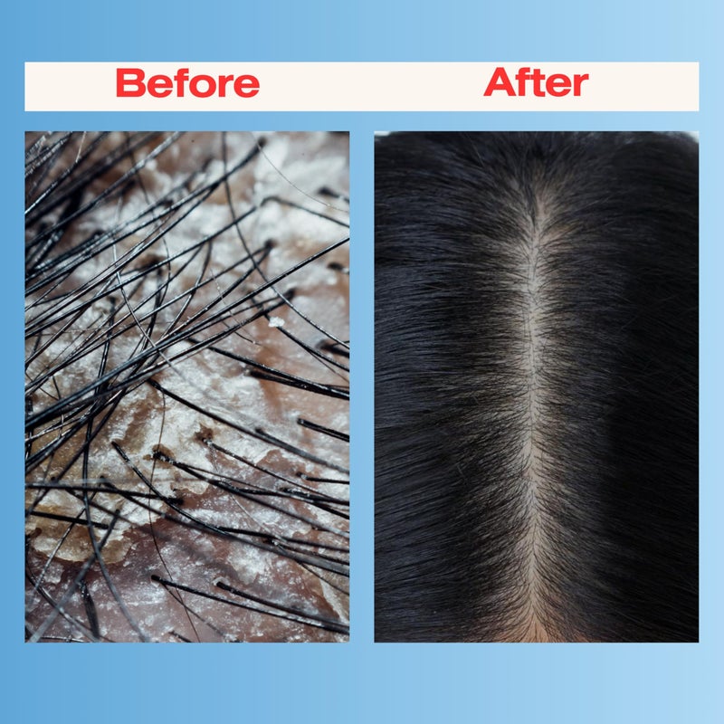 Mediceuticals Therapro Mediceuticals Scalp Treatment - 3 Piece Kit (for Dandruff & Psoriasis) - Image 5