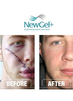 New Gel+ Advanced Medical-Grade Silicone Gel+ Vitamin E for All Scar Types 15g  - Image 5