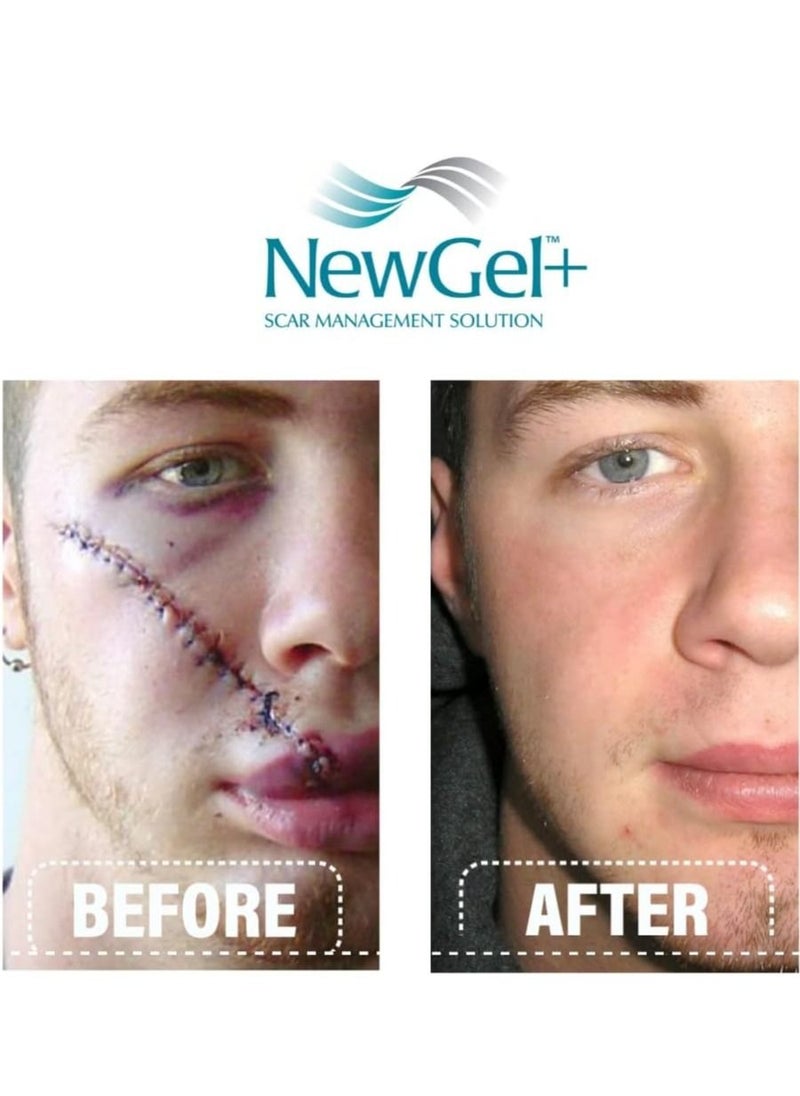 New Gel+ Advanced Medical-Grade Silicone Gel+ Vitamin E for All Scar Types 15g  - Image 5