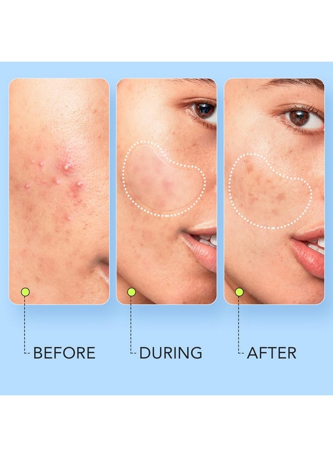 LitBear LitBear Large Pimple Patches (7 Sizes 112 Patches), Big Acne Patches, XL Hydrocolloid Bandages for Full Face, Forehead, Chin, Nose, Body, Back, Neck & Chest, Oval, Moon, Square hydrocolloid Patch  - Image 4