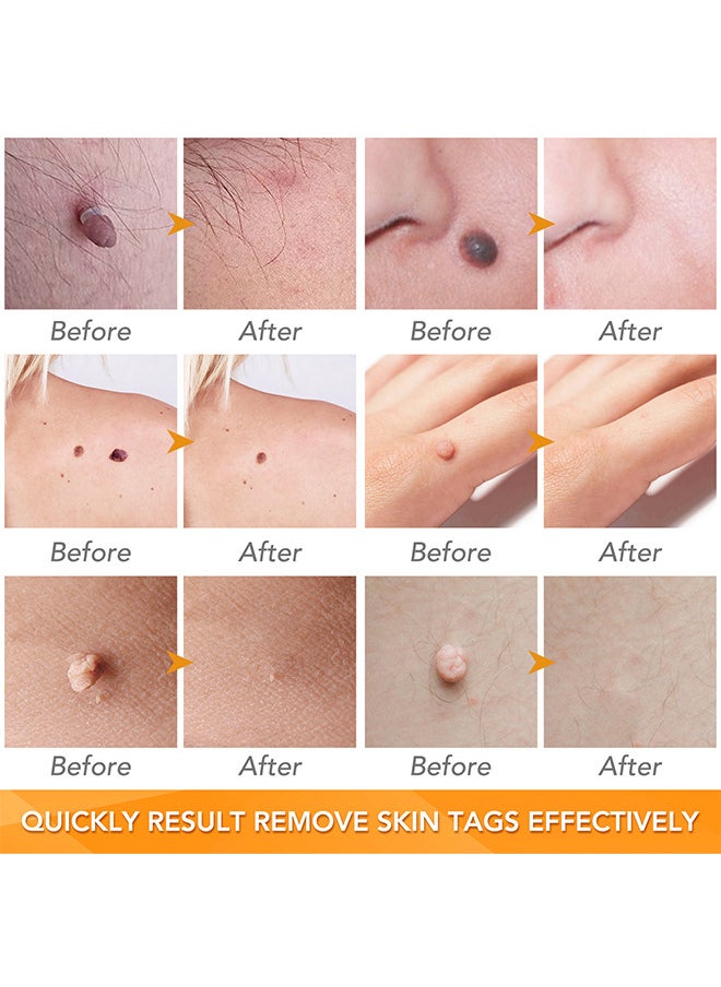 Sefudun - 2 In 1 Skin Tag Removal Tool Kit Painless Easy-Using Device For Small To Large Sized Skin Tag On Face Neck And Body， Double Head Wart Removal Tool Skin Tag Removal Orange - Image 1