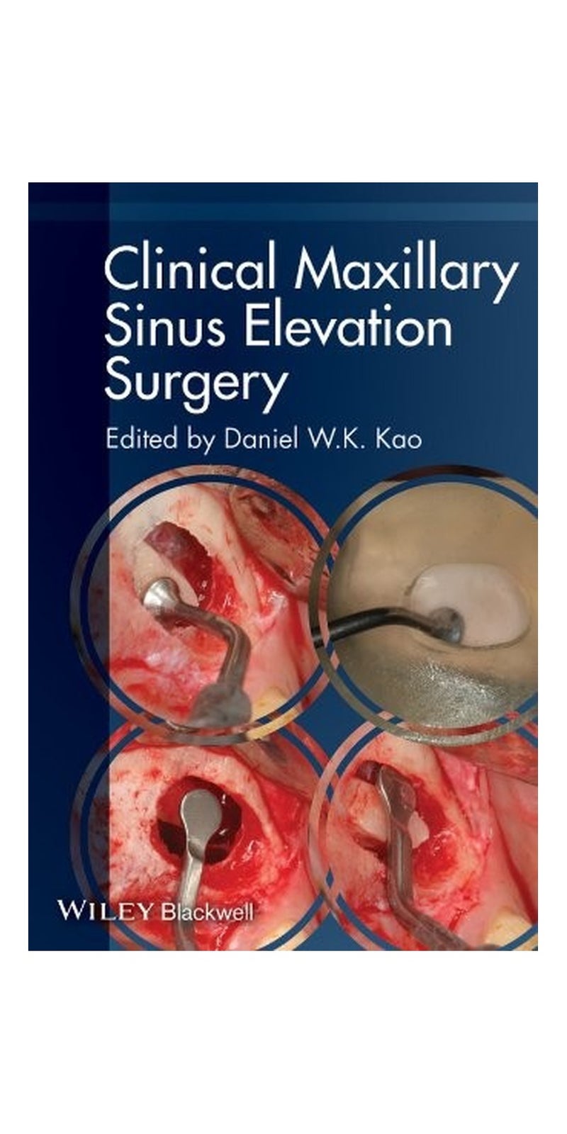 Clinical Maxillary Sinus Elevation Surgery | Paperback | Published by Wiley-Blackwell