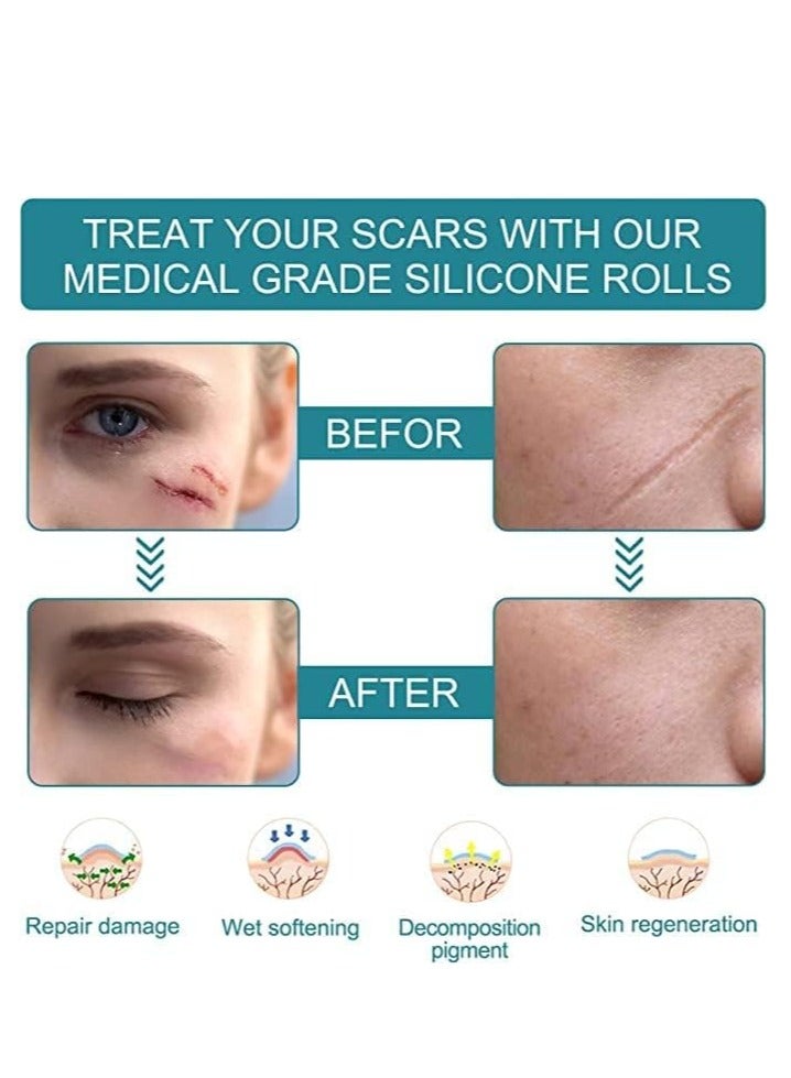 Silicone Scar Tape, Medical silicone scar remover sheet, stretch marks treatment waterproof silicone scar sheet 4cmx1.5m