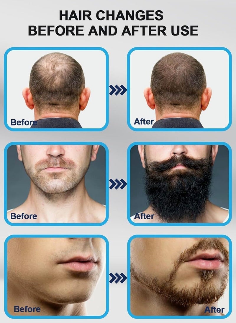 كيلا أداة ديرما ستامب مايكرونيدلينج للتجميل - قلم تجميل احترافي قابل للتعديل للنساء والرجال - أداة للعناية بالبشرة والشعر واللحية تحتوي على 140 إبرة للاستخدام المنزلي الأمثل للرجال والنساء (أبيض) - Image 5