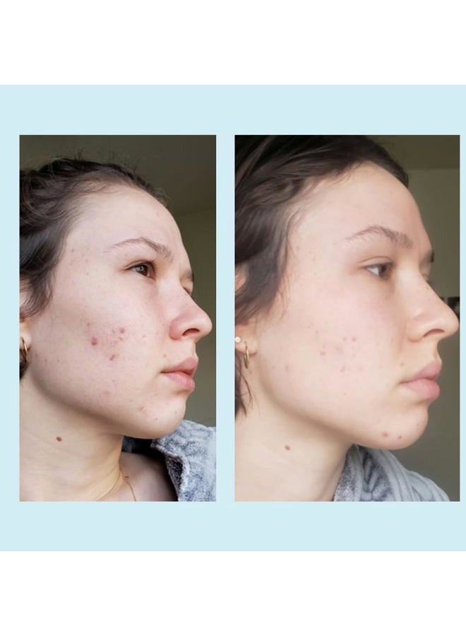 PERFECT IMAGE Glycolic Acid 50% Gel Peel - Enhanced with Retinol & Green Tea Extract (Professional Skin Peel)1 ounce - Image 4