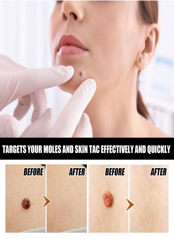 EELHOE - Organic Tags Solutions Serum, Mole Corrector Skin Tag Remover, Organic Skin Spot Purifying Serum Tags Free Mole & TAG Removal New-All Natural (1Pcs) - Image 1