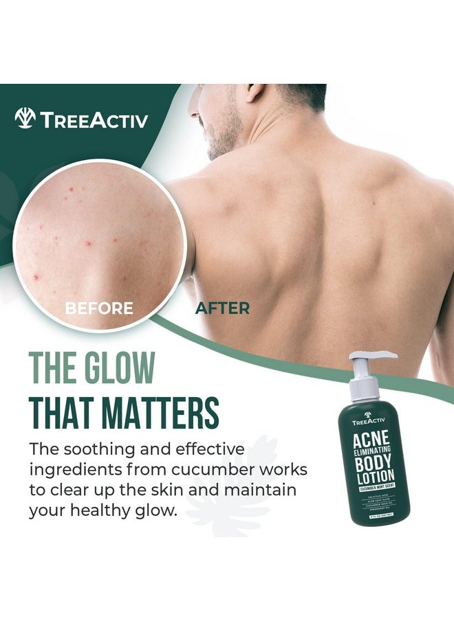 TreeActiv TreeActiv Acne Eliminating Body Lotion, 8 fl oz, Salicylic Acid Lotion, Salicylic Acid Body Acne Treatment, Back Acne Treatment Cream for Women and Men, Acne Lotion for Body, Zit Cream with 2000+ Uses  - Image 4
