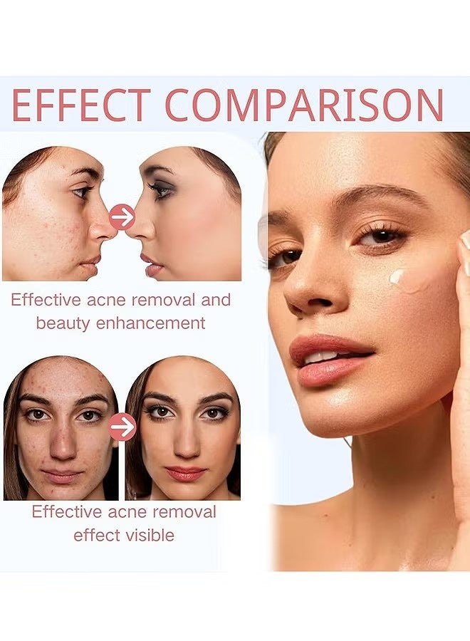 FUSHITING Azelaic Acid 15% Acne Tratment Cream, Acne Cream for Face, Spot Treatment, Anti Acne Gel For Spot Prone Skin, Rosacea Reducing Relief Pimple Breakouts Blackhead Pigmentation and Redness,Hydrate 15g - Image 2