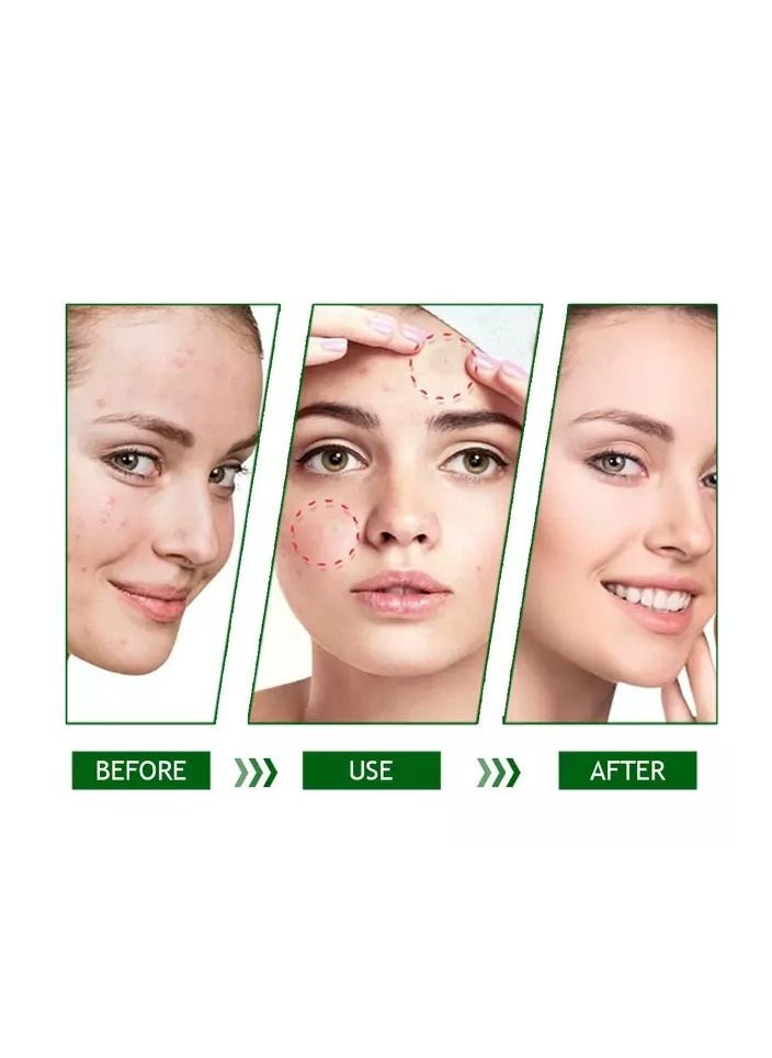 West&Month - 24 Patches Acne Pimple Patch Invisible Hydrocolloid Spot Skin Treatment for Face Fast Healing Transparent strong Adhesive Pimple Stickers - Image 1