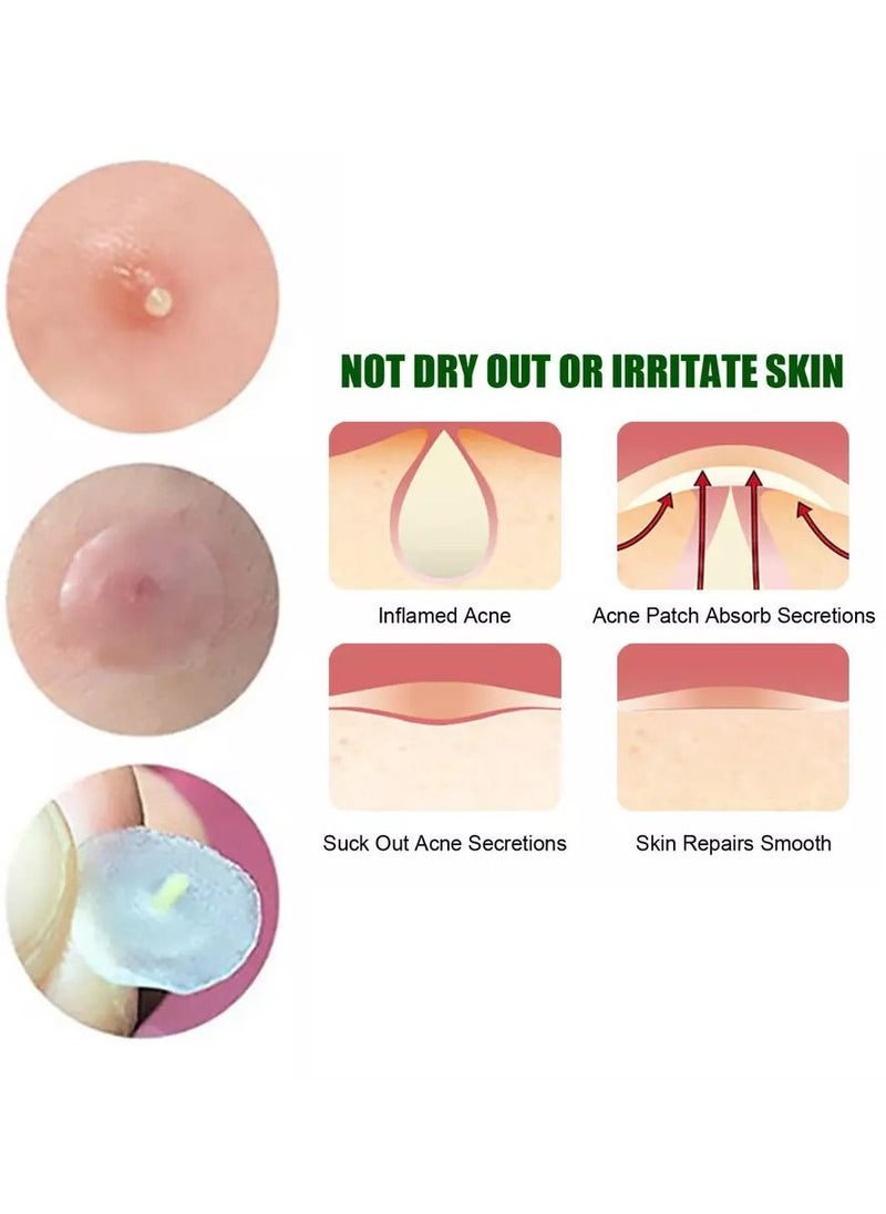 West&Month - 24 Patches Acne Pimple Patch Invisible Hydrocolloid Spot Skin Treatment for Face Fast Healing Transparent strong Adhesive Pimple Stickers - Image 1