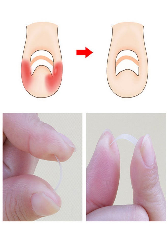 Ingrown Toenail Correction Set Toenail Treatment Toenail Straightening Patch Lifter Fixer Recover Tool Foot Care Kit - Image 2