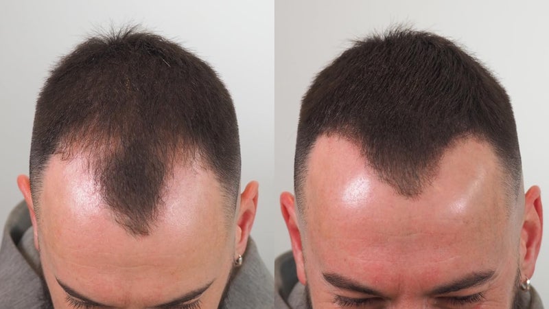 Thick Fiber ألياف شعر سميكة باللون الأسود 12 جرام - ألياف شعر لتكثيف المناطق الرقيقة والصلع للرجال والنساء - عبوة 1 من 12 جرام - Image 4