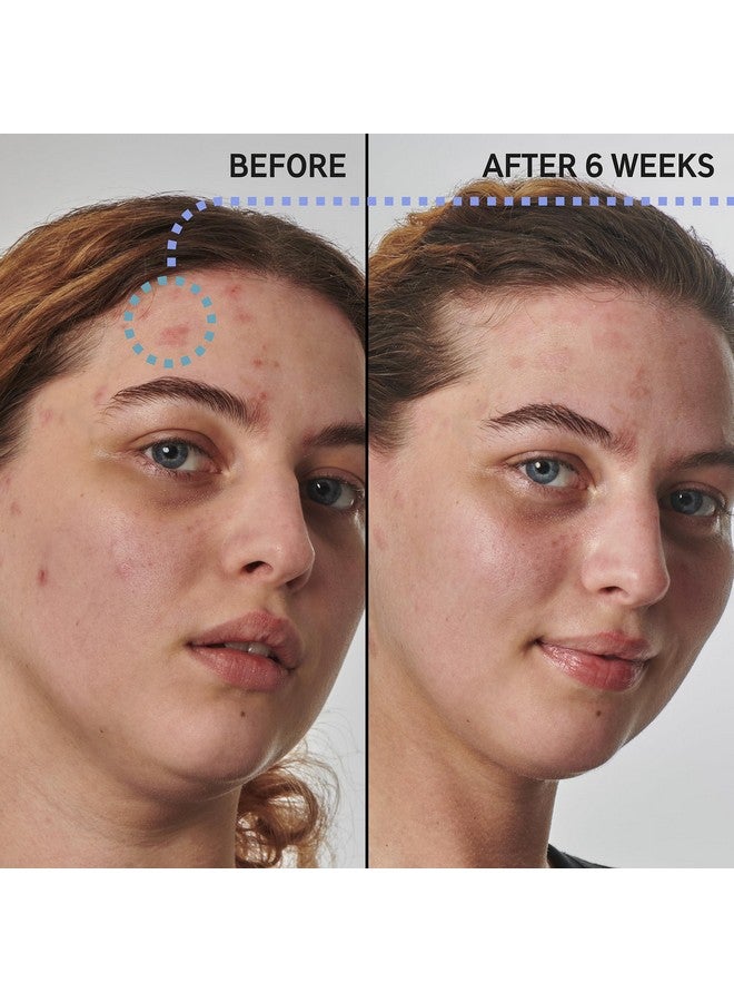 The INKEY List Supersolutions Urea 10% Moisturizer Quickly Helps To Hydrate Nourish And Soothe Dry Skin Gently Exfoliates Urea Moisturizer For Face 1.69 Fl Oz - Image 2