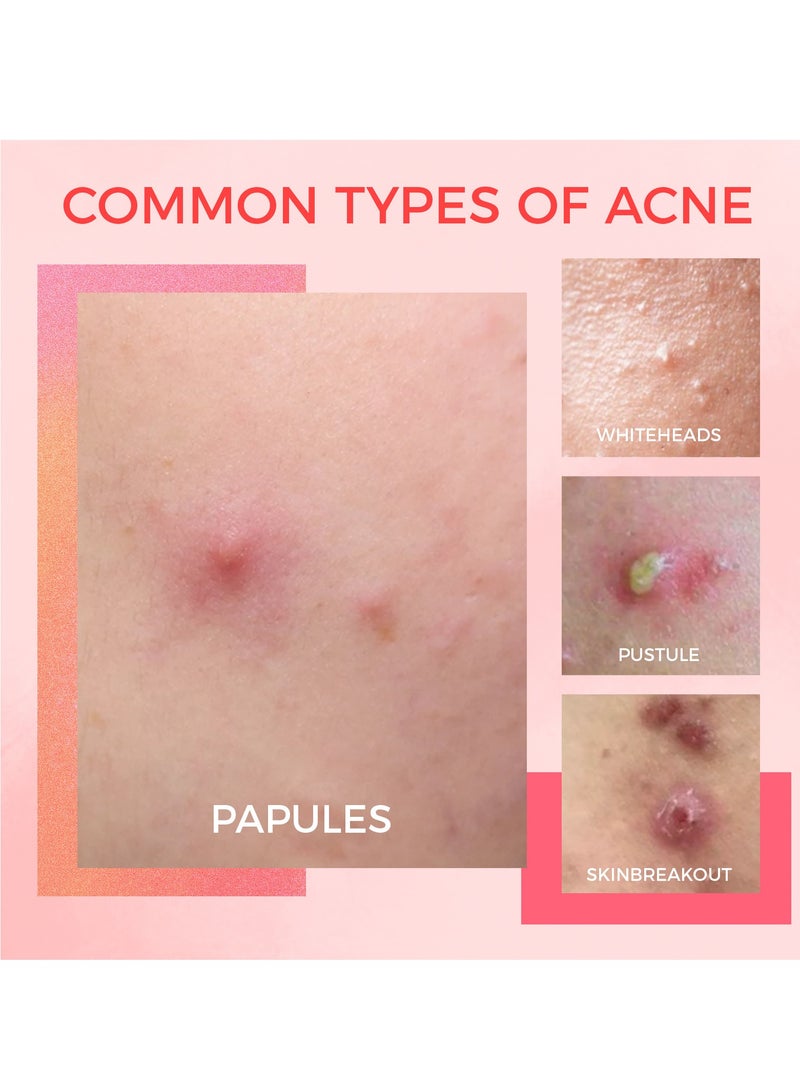 OUKEYA Acne Drying Lotion with Salicylic Acid – Double Acid Formula for Acne-Prone Skin, Oil Control, Redness Relief, Fade Marks – 29ml - Image 5