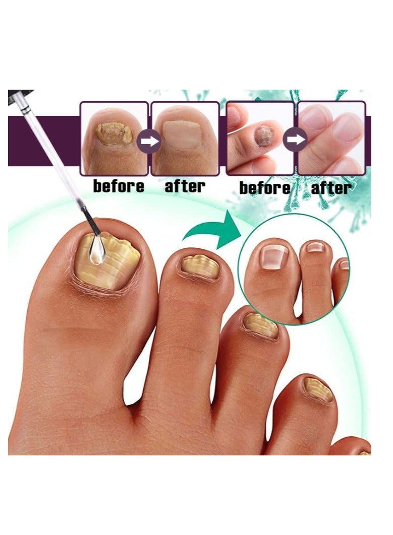 ERAYCEE Fungal Nail Treatment Liquid Nail Fungus Treatment for Toenails & Fingernails Fungal Nail Renewal Anti Fungus Nail Repair Smooth & Hydrates Nail Reduce Discoloration 30ml - Image 2