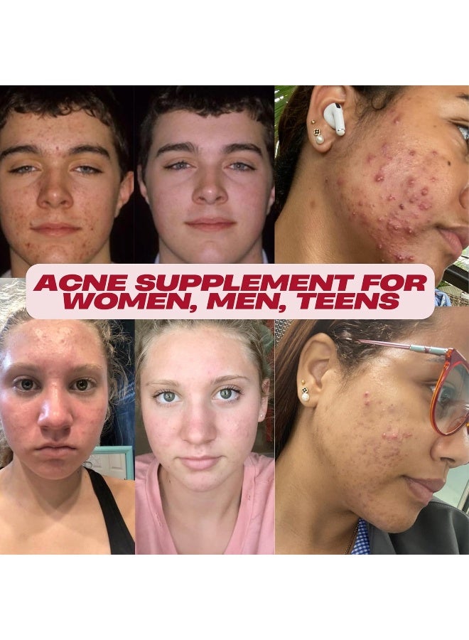 Acnetame Vitamin Supplements for Acne Treatment - 60 Pills - Image 2