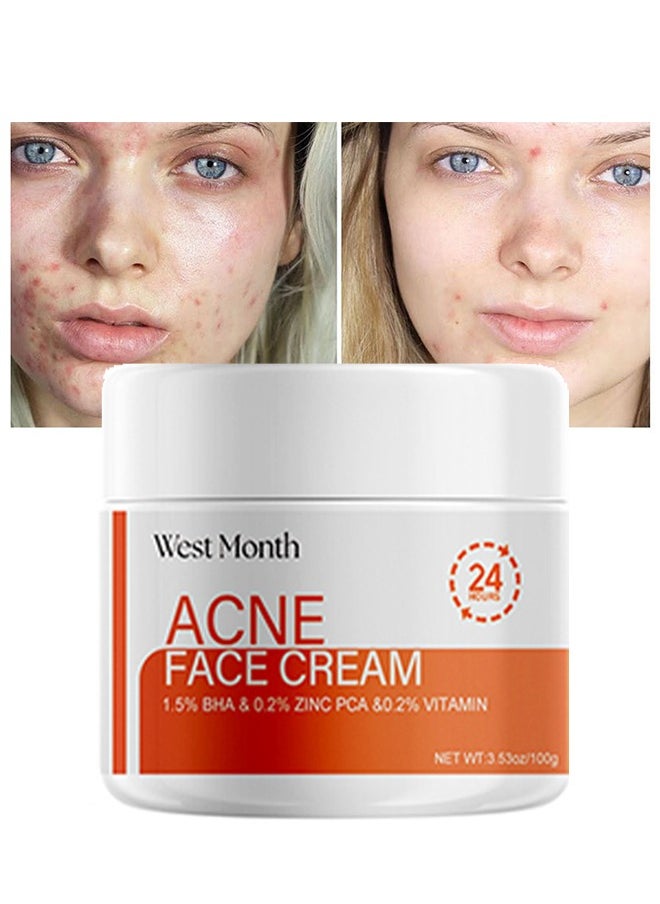 West&Month Acne Face Cream, Acne Spot Treatment for Face & Acne Dots, Natural Cystic Acne Treatment, For All Skin Types, Premium Acne Scar Cream & Pimple Remover 100g  - Image 1