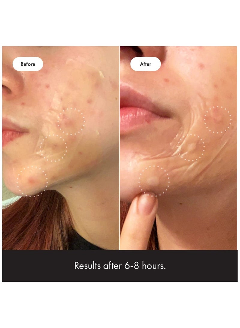 Mighty Patch Surface - Hydrocolloid Large Acne Pimple Patch Spot Treatment (10 count) for Body and Larger Breakouts on Cheek, Forehead, Chin, Vegan, Cruelty-Free, 50% Better Absorption - Image 4