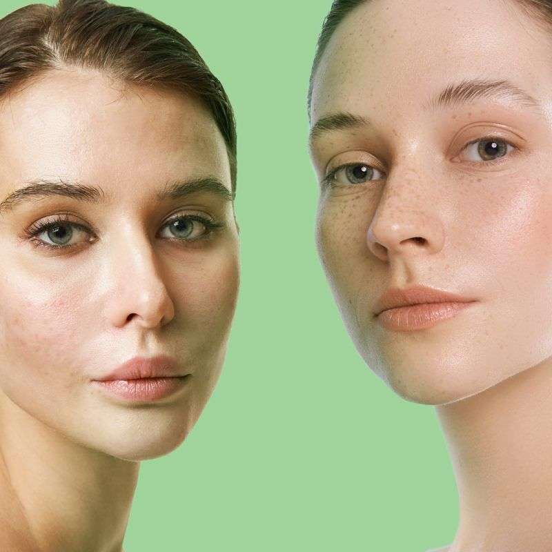 Dermactive Clear Global AC Cream Gel 50 ML - Image 3