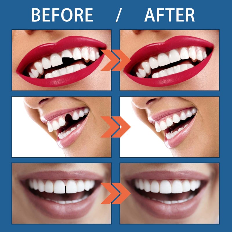 Moldable False Teeth: White Superb Resin Vivid & Distinctive Denture Cosplays Accessories - Endurable Wear-resistant Portable Prop Decoration for Halloween Party Cosplay - Image 2