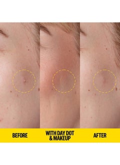 بقع حب الشباب النهارية من Skincare Acne Day Dot Jumbo | بقع حب الشباب الغروانية الشفافة سريعة المفعول لمدة 6 ساعات مع حمض الساليسيليك | رقيقة للغاية وغير مرئية تقريبًا | تزيل البثور والبقع بسرعة (40 نقطة) - pzsku/Z4F0832781491C32AE195Z/45/_/1686397332/66981aa4-d720-42ec-a376-288751b1a411