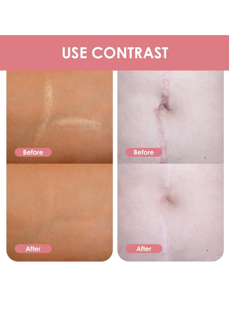 Excefore Silicone Scar Sheets, Silicone Scar Tape Roll, 8 Pack Scar Removal Gel Patches, Easy-Tear Gel Tape For Scar, Soft Silicone Scar for Surgery Scars, Medical Silicone Scar Repair Sheets - Image 4